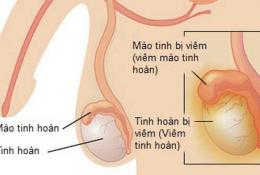 nguyen-nhan-trieu-chung-viem-tinh-hoan